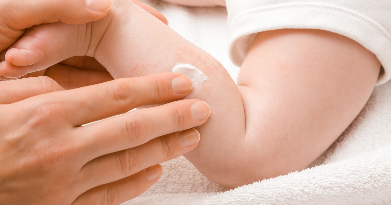 赤ちゃんの皮膚を理解しましょう 皮膚科医監修 セタフィル 公式サイト